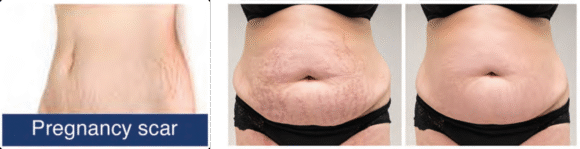 Radiant Aurora Microneedling