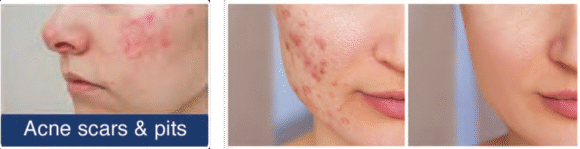 Radiant Aurora Microneedling