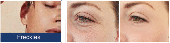 Radiant Aurora Microneedling