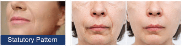 Radiant Aurora Microneedling