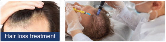 Radiant Aurora Microneedling